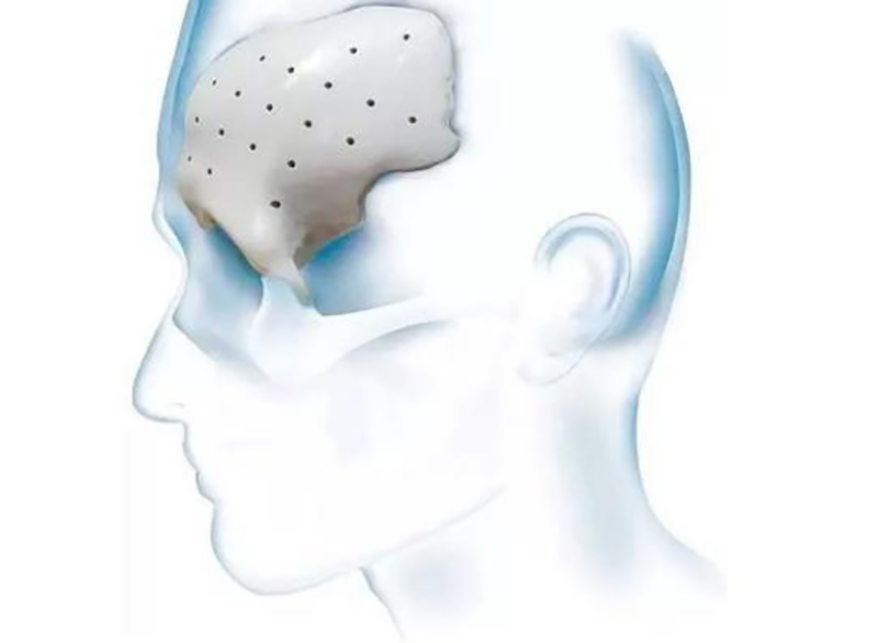 康拓醫(yī)療科（PEEK材料修補(bǔ)產(chǎn)品生產(chǎn)商）科創(chuàng)板IPO審核過會(huì)